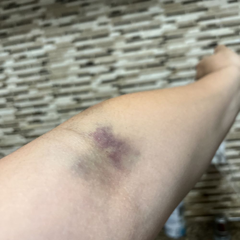 CSL Plasma - How they left me Both arms after trying to donate for the first time - Blood & Plasma Donation Centers Near Me - Riverside, California CSL Plasma - How they left me Both arms after trying to donate for the first time - Blood & Plasma Donation Centers Near Me - Riverside, California