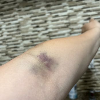 CSL Plasma - How they left me Both arms after trying to donate for the first time - Blood & Plasma Donation Centers Near Me - Riverside, California