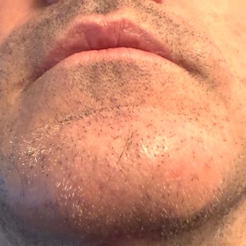 Jacob Sedgh, MD - Misaligned chin implant protruding inside mouth. - Cosmetic Surgeons Near Me - West Hollywood, California Jacob Sedgh, MD - Misaligned chin implant protruding inside mouth. - Cosmetic Surgeons Near Me - West Hollywood, California