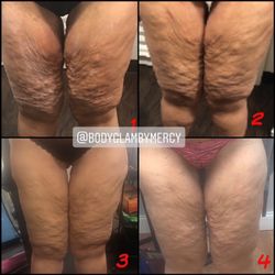 Body Glam by Mercy - Aggressive Cellulite treatment