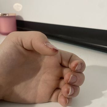 Designer Nails - Blood and blisters under my nails - Nail Salons Near Me - Longmont, Colorado