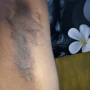 Bombshell Waxing - Metairie - This is my skin 2 years after the initial burn. Sept of 2018 to Oct 2020 - Waxing Near Me - Metairie, Louisiana Bombshell Waxing - Metairie - This is my skin 2 years after the initial burn. Sept of 2018 to Oct 2020 - Waxing Near Me - Metairie, Louisiana