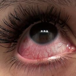 Scratched Sclera from lash tech wiping it