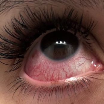 Umi Lash & Beauty - Scratched Sclera from lash tech wiping it - Eyelash Service Near Me - La Mirada, California