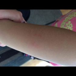 Jack & Jill's Educational Center - DISGUSTING BITE ON GRANDDAUGHTERS ARM!!!