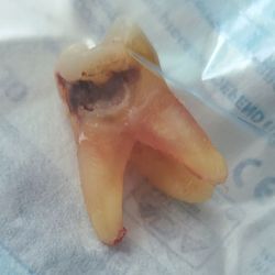 One Dental Tacoma - Eviction Day - 1 piece!