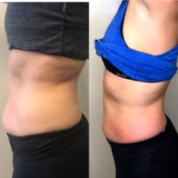 Precise Micro Beauty - Cryoskin Slimming Abdomen Treatments