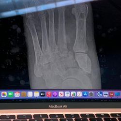 Hanger Clinic : Prosthetics & Orthotics - Broken foot