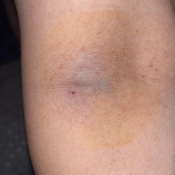 CSL Plasma - My girlfriends bruise