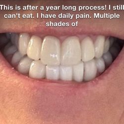 Comfort Dental West Tacoma - Started with Dr Turley at Denovo Dental, he moved me to his general dentistry office for unknown reasons where it got worse.