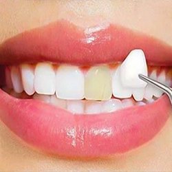 Pauline Lu, DDS - Procelain Veneers