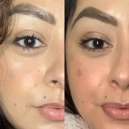 Melasma- right is before and left is after 3 sessions. Minimal makeup and no concealer in both. Melasma- right is before and left is after 3 sessions. Minimal makeup and no concealer in both.