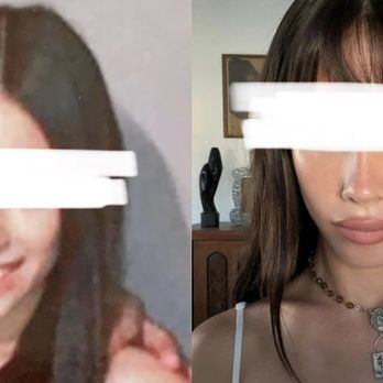 Ari Hyman, MD - Before and after - Cosmetic Surgeons Near Me - Encino, California
