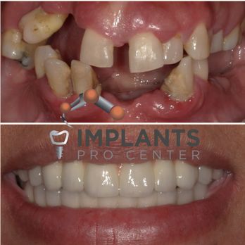 Implants Pro Center - Mohamed Ali, DDS - Cosmetic Dentists Near Me - San Francisco, California Implants Pro Center - Mohamed Ali, DDS - Cosmetic Dentists Near Me - San Francisco, California