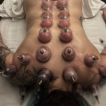 Family Massage - Cupping with Jonathan - Massage Therapy Near Me - Murrieta, California Family Massage - Cupping with Jonathan - Massage Therapy Near Me - Murrieta, California