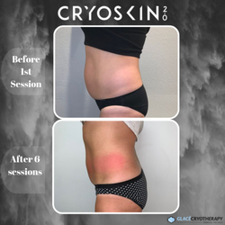 R3 Chattanooga  - CryoSlimming results~