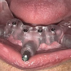Carlos Abreu - Bone-borne All n' 4 Surgical Guide