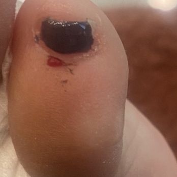 Chill Nails - Bleeding and open cut from going to hard with his tool - Nail Salons Near Me - North Hollywood, California