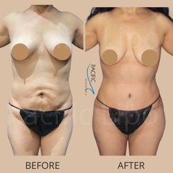 Pacific Lipo - Newport Beach - Tummy tuck