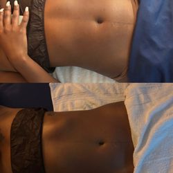 Bare Fruit Body Lab - A deluxe Lipo cavitation session including Lymphatic drainage