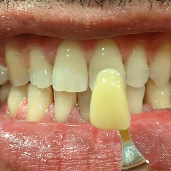 Smiles for You - This client was the darkest shade and did three treatments and went give shades lighter. - Teeth Whitening Near Me Smiles for You - This client was the darkest shade and did three treatments and went give shades lighter. - Teeth Whitening Near Me