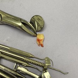 Family Dental Care - Wisdom tooth