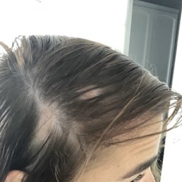 Bald spots after removal Bald spots after removal