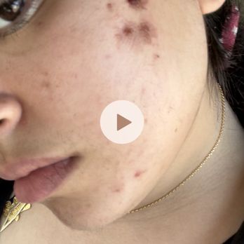 Dari Perly Studio - Results of the "facial" where she added a chemical peel without my authorization - Skin Care Near Me - Philadelphia, Pennsylvania
