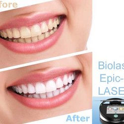 Laser tooth whitening with the latest technology