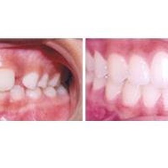Ian Lennard, DDS MS - Deep overbite with crowding - Orthodontists Near Me - San Jose, California Ian Lennard, DDS MS - Deep overbite with crowding - Orthodontists Near Me - San Jose, California