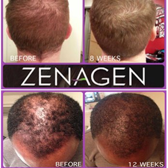 Zenagen Hair Thickening Treatment For Men And Women Yelp