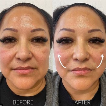 Btoxbar - Before & after PDO thread lift - Medical Spas Near Me - Los Gatos, California Btoxbar - Before & after PDO thread lift - Medical Spas Near Me - Los Gatos, California