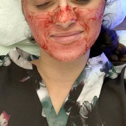Kristina Kushner Aesthetics - Micro-needling