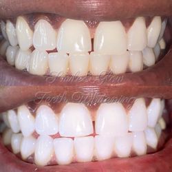 Smile and Glow Teeth Whitening - 20 minutes zoom touch up