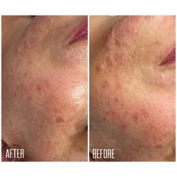 Lovely Beauty Palace - Aqua Facial Treatment
