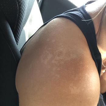 SUGARED + BRONZED - Only 2 days out and already splotching despite moisturizing. Very disappointed this time around :( - Tanning Near Me - Santa Monica, California SUGARED + BRONZED - Only 2 days out and already splotching despite moisturizing. Very disappointed this time around :( - Tanning Near Me - Santa Monica, California