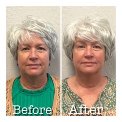 Renewed Vitality and Wellness - Skinvive by Juvederm