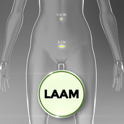Paul J. Mackoul, MD - The innovative LAAM approach is used at CIGC to perform laparoscopic myomectomy. Learn more: https://innovativegyn.com/techniques/laam/