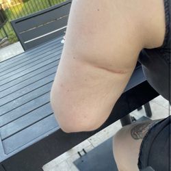 David Azouz, MD - Scar from arms liposuction