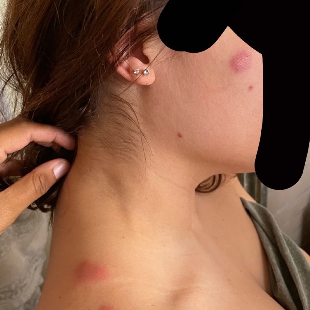 bed bug bites
