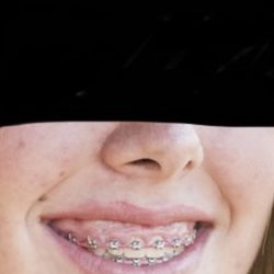 Packard Family Orthodontics - Pre-gummy smile.