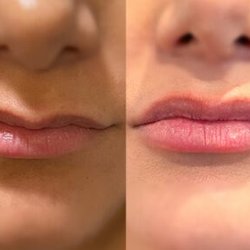 Derma Fillers