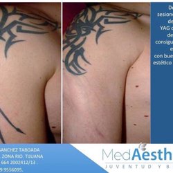 Med Aesthetic - Retiro de tatuajes.. Rápido y efectivo .