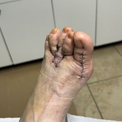 Alabama Family Foot Clinic - After surgery- still messed up!