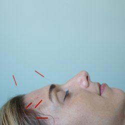 C3 Acupuncture