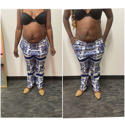 Beauty Beyond Perfection - Before and after Cavitation with Radio Frequency and Suctioning
