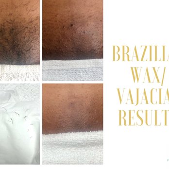 Pristine Esthetics Beauty Bar - Brazilian Wax/ Vajacial results. Vajacial includes cleanse, exfoliation, extractions of ingrown hairs, brightening after treatment mask. - Skin Care Near Me - Lakewood, California Pristine Esthetics Beauty Bar - Brazilian Wax/ Vajacial results. Vajacial includes cleanse, exfoliation, extractions of ingrown hairs, brightening after treatment mask. - Skin Care Near Me - Lakewood, California