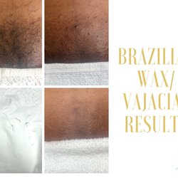 Pristine Esthetics Beauty Bar - Brazilian Wax/ Vajacial results. Vajacial includes cleanse, exfoliation, extractions of ingrown hairs, brightening after treatment mask.