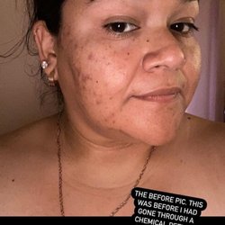 La Bella Skin - Client showing her before and after 3 chemical peels with us