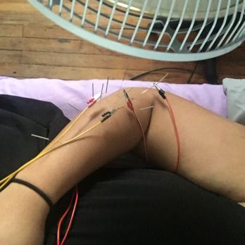 Hima Acupuncture - Manhattan - needles with electric stimulation - Acupuncture Near Me - New York, New York